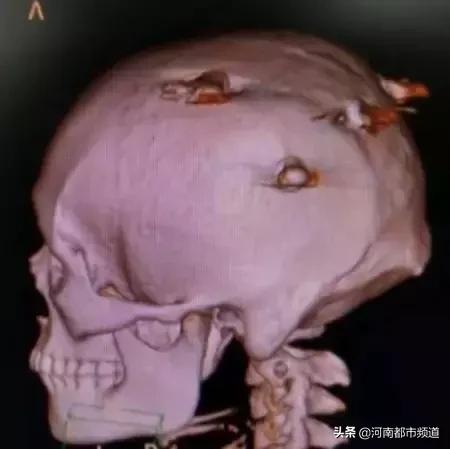 小伙反复头晕查出脑瘤,男子持续头痛竟是脑内有炸弹