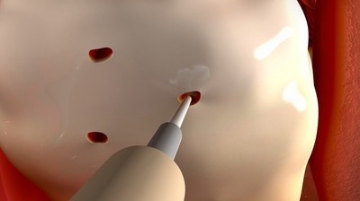 多囊卵巢促排卵针一般打几天,多囊卵巢综合征促排卵怎么治疗