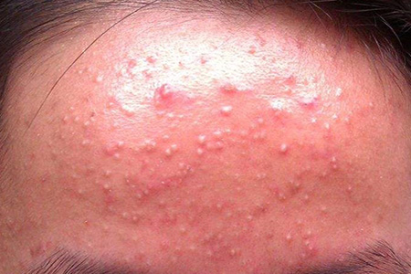 好用祛痘国货老品牌推荐,国货祛痘最好的牌子