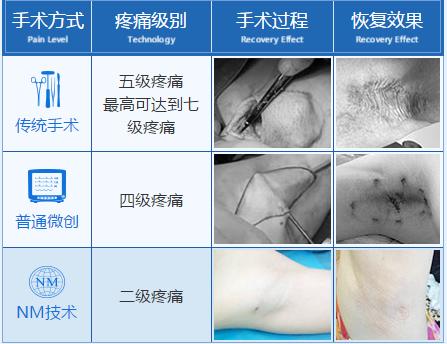 可视微创腋臭手术哪个医院好,宁波微创腋臭手术哪家好