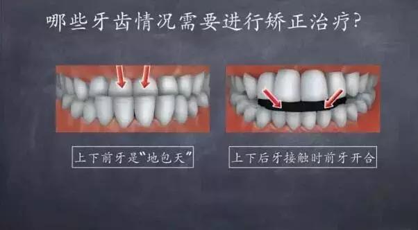 牙齿矫正拔牙后会反弹成原样么,牙齿矫正后反弹可以重新矫正吗