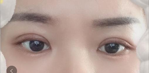 眼球突出割双眼皮好看吗,割双眼皮的危害