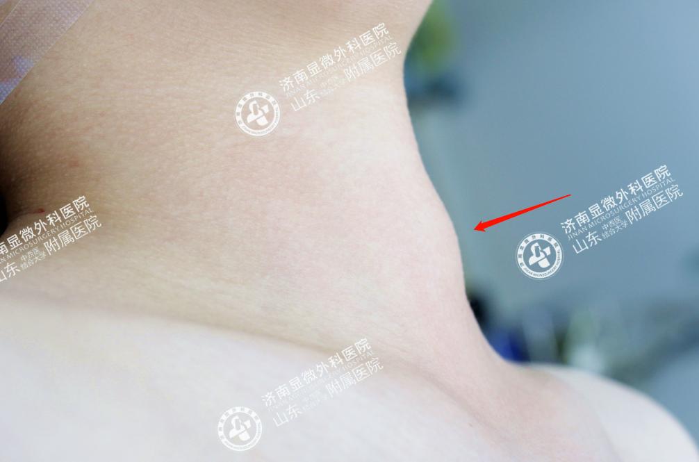 甲状腺结节该不该手术这篇说全了,甲状腺结节到底开刀好还是微创好