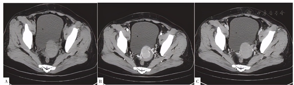 病例分享:子宫恶性血管周上皮样细胞肿瘤