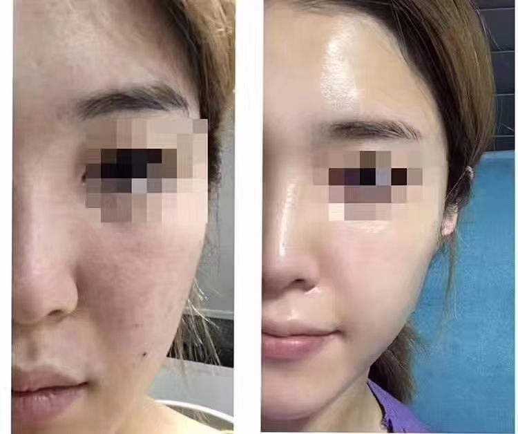 角质层增厚了皮肤好了,角质层健康