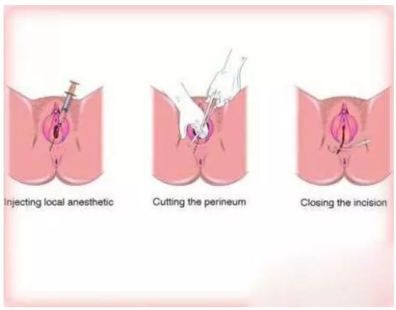 顺产一定要侧切吗？资深产科医生告诉你答案