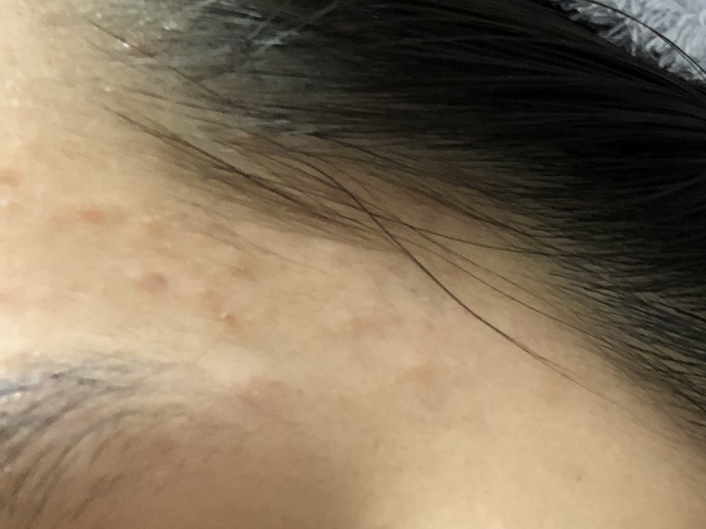 17岁女儿脸上长满痘痘，看了这篇文章才知道如何帮助她