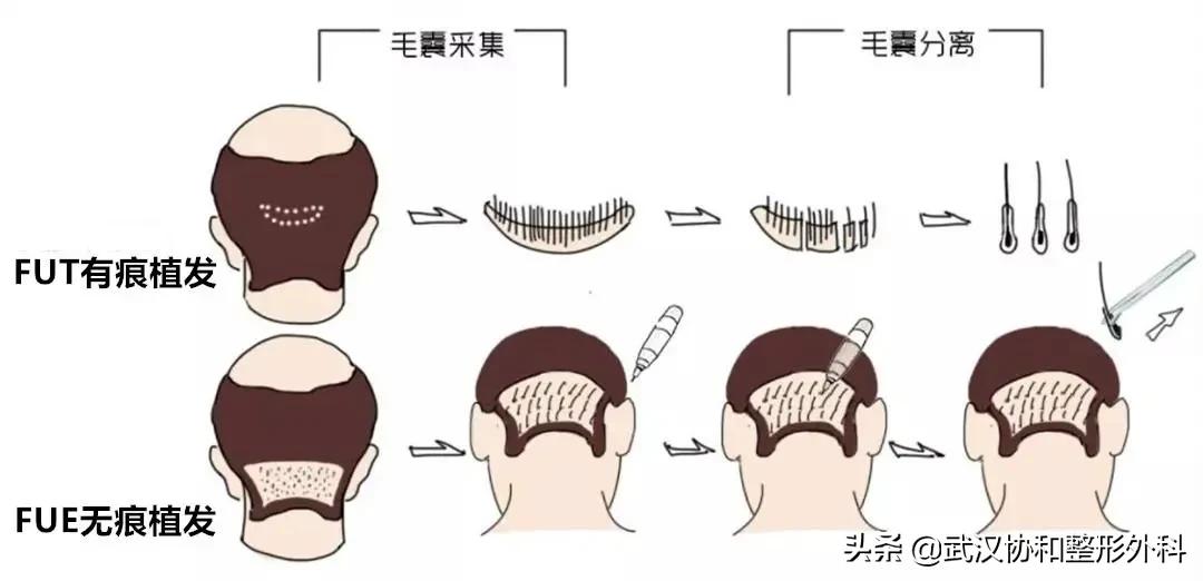 植发的十大潜规则,植发快问快答