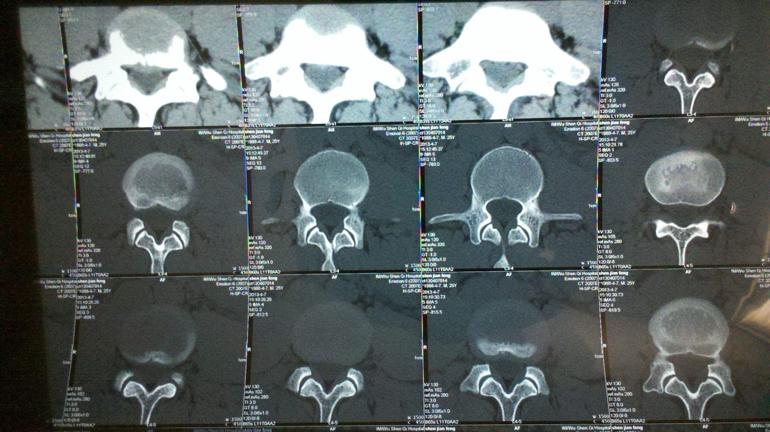 现在治疗腰椎间盘突出最新方法,治疗腰椎间盘突出最快的恢复方法