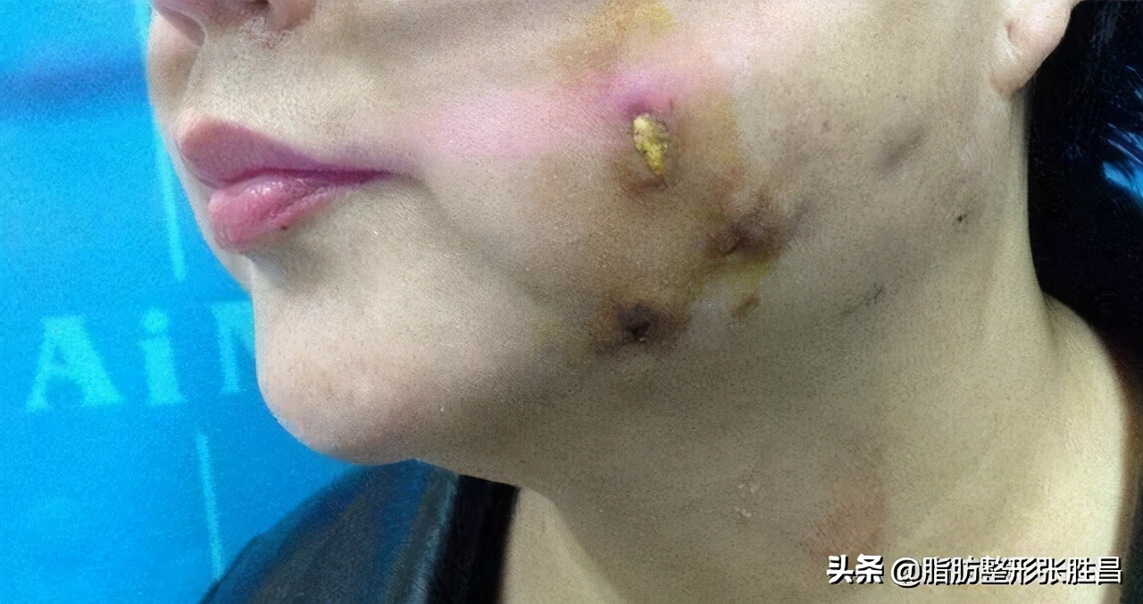 想瘦但又不想减肥,注射溶脂针还能吸脂吗