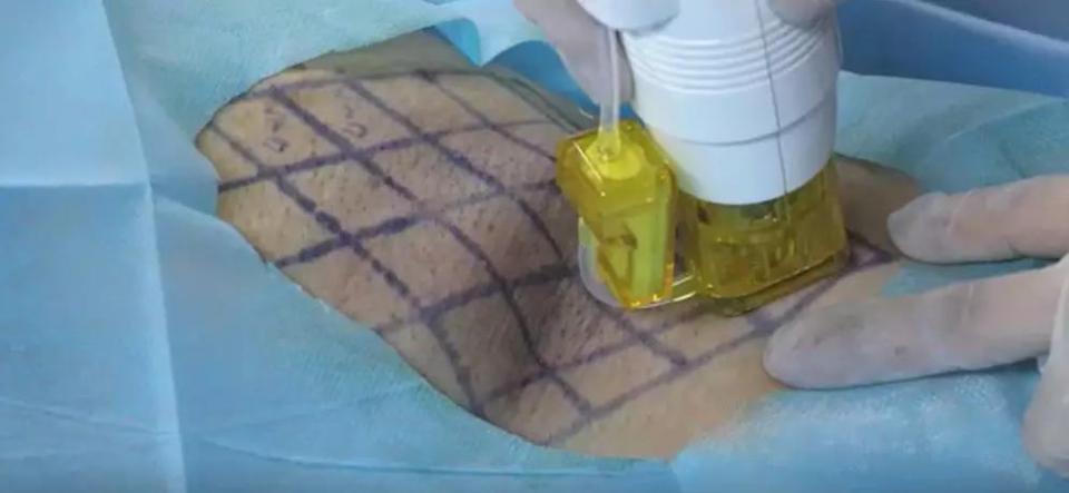 黄金微针射频治疗腋臭原理,微等离子射频无创治疗腋臭