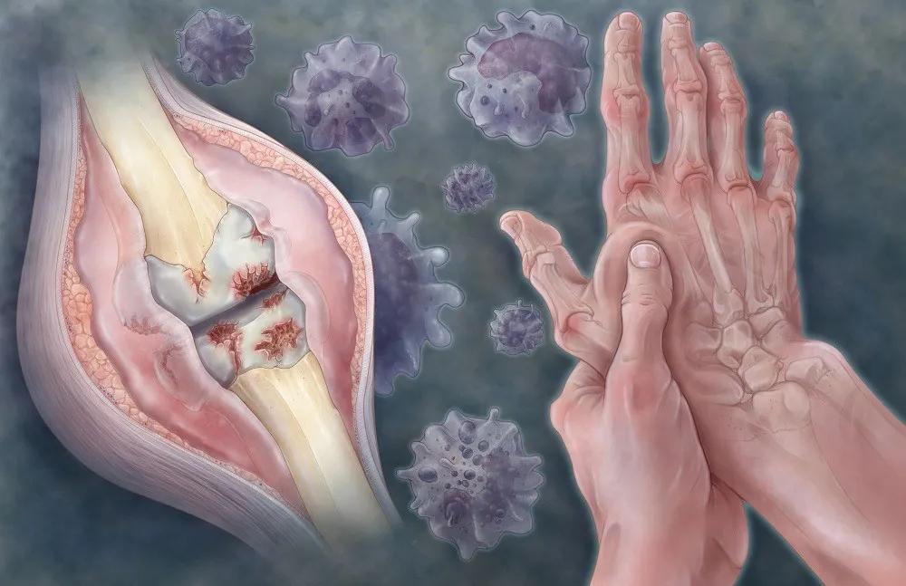 疫情期间，类风湿性关节炎急性发作应这样处理，否则追悔莫及