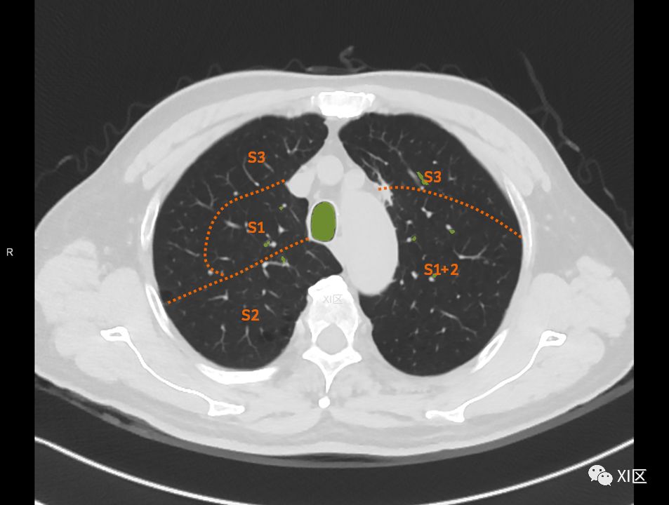 如此详细的肺部影像解剖，有点儿酷