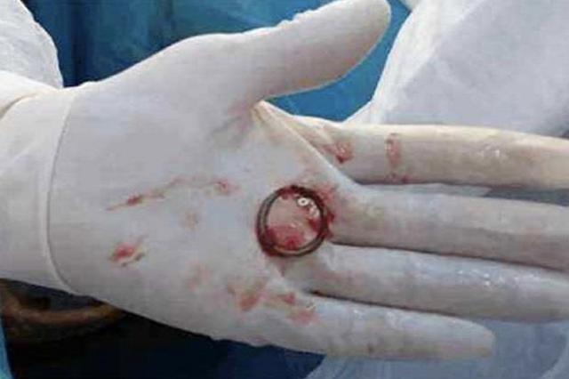 女人生完小孩就结扎,生了2胎后需要结扎吗