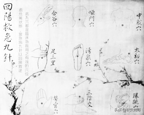 回阳九针的视频,回阳九针穴针灸视频