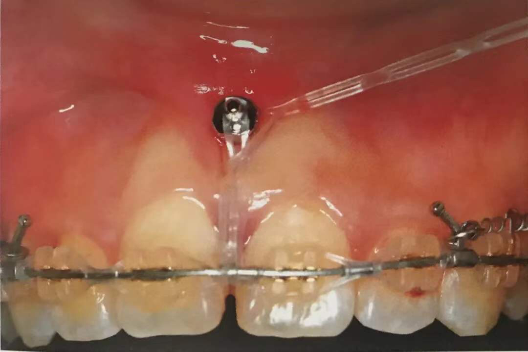 矫正牙齿在牙龈打钉子多久能取,整牙一定要在牙龈里打钉子吗