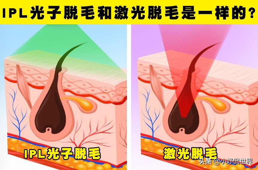 女性脱毛骗局,来看看脱毛误区你中了几个