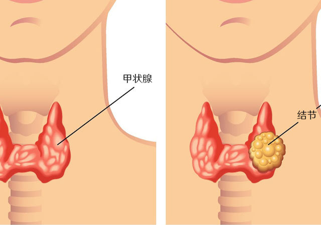 结节不用做手术，吃药就能好？这些情况需要注意