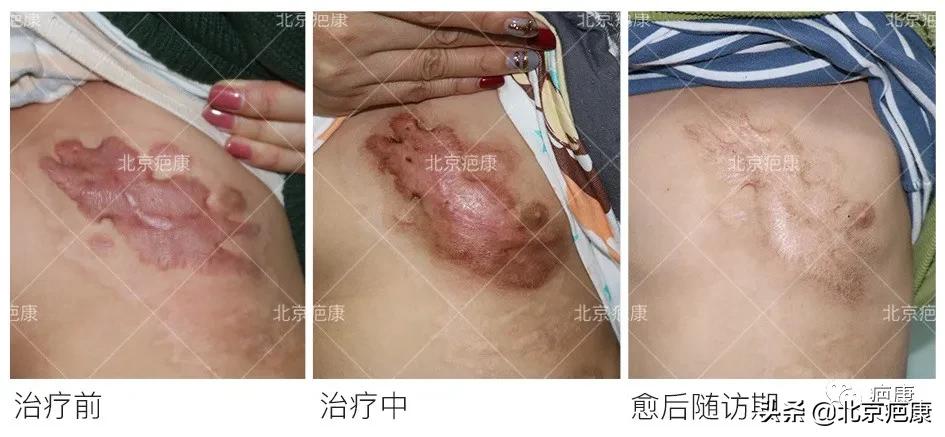 孩子烧伤疤痕，单纯预防多长时间能看到效果？