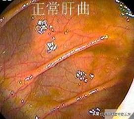 结肠镜检查，痛苦并快乐着