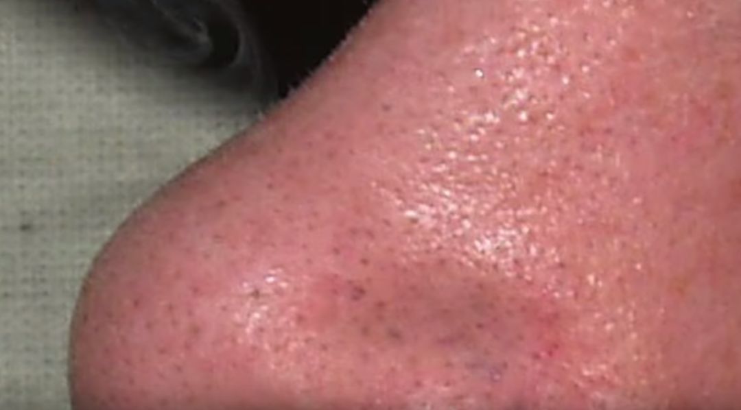 脸上的黑头粉刺挤不出来怎么办,脸部黑头粉刺有必要去美容院挤吗