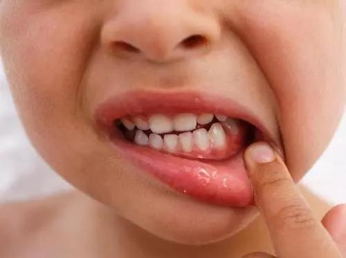 孩子牙齿很久未长出需要干预吗,小孩子牙齿不往外长