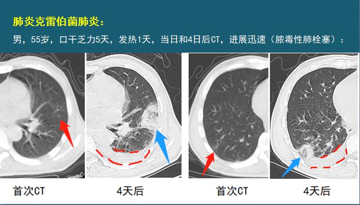 糖尿病不注意饮食的危害科普视频,糖尿病不忌口吃糖的后果
