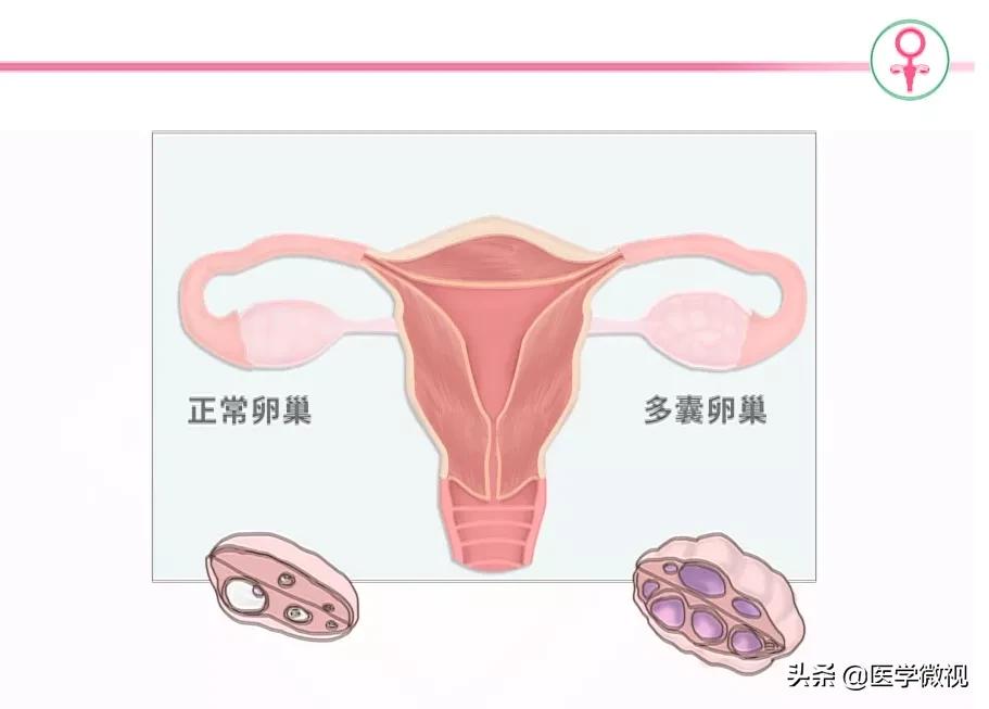 姑娘，别被多囊卵巢综合征吓坏！卵子质量不好≠无法生育