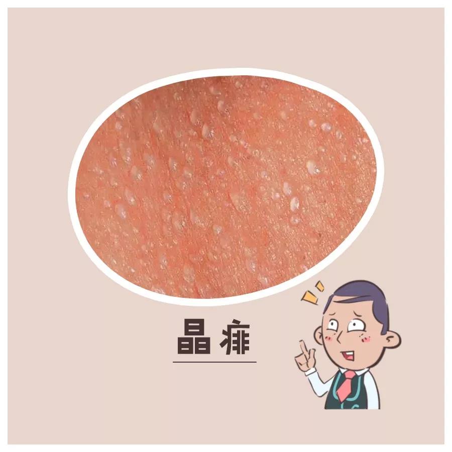 天热起痱子怎么能去根,天热痱子用什么药材治呢