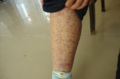 腹型过敏性紫癜的症状特点有哪些,腹型过敏性紫癜与普通腹痛的区别