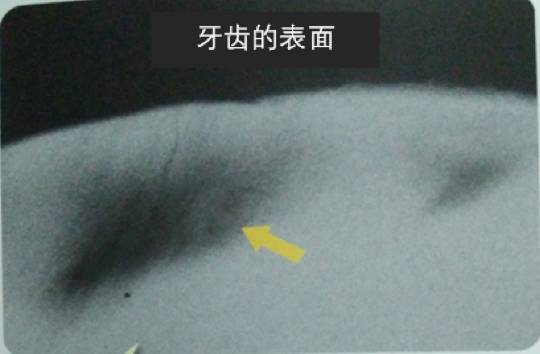 为什么牙齿会蛀牙儿童科普,儿童牙齿长白点是蛀牙吗