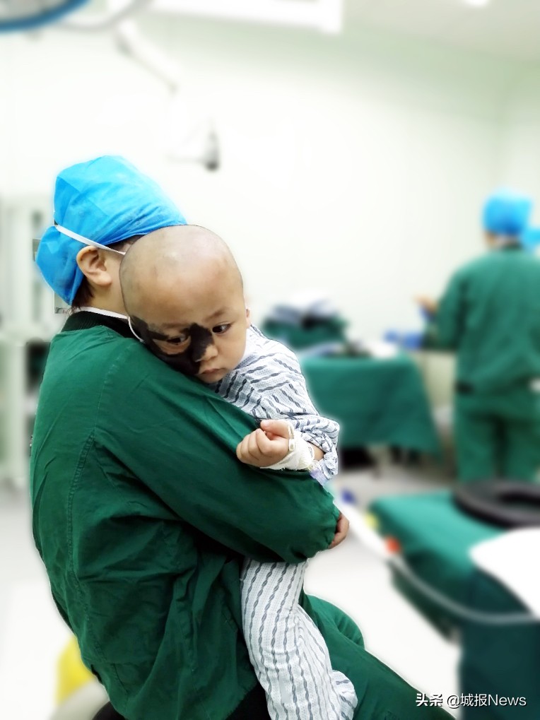 “巨痣”症男童有望告别“熊猫脸”