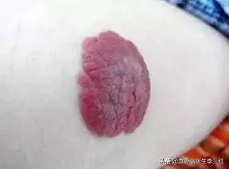 血管瘤会不会自行消退,血管瘤自己消退是不是就是好了