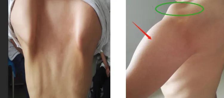 强直性肌营养不良该如何锻炼,肌进行性营养不良加强锻炼能好吗