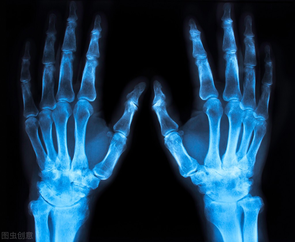 类风湿关节炎要怎么治效果最好,重度类风湿性关节炎现有治疗手段