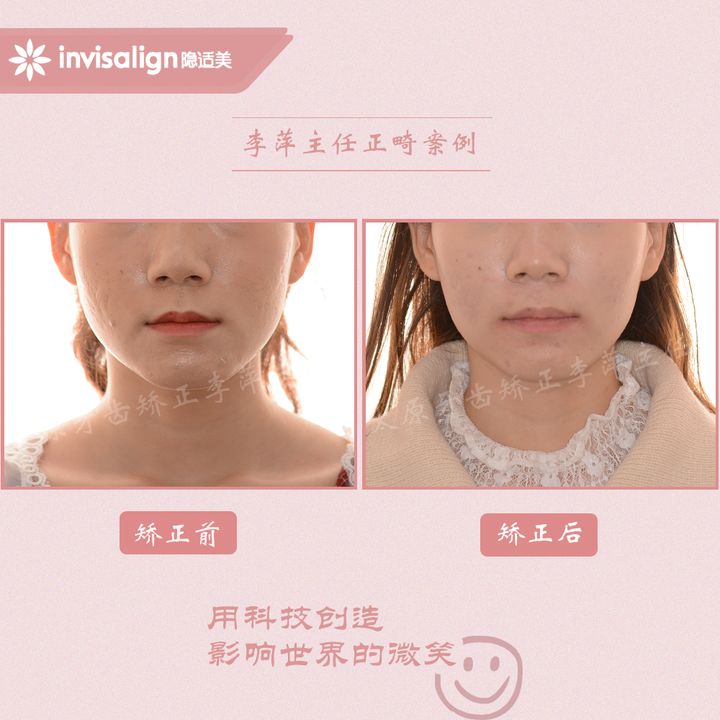 太原矫正牙齿需要做正颌吗,太原牙齿二次矫正