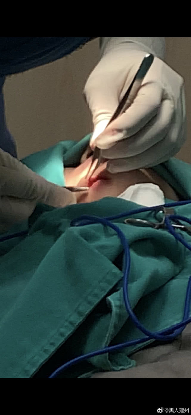 范玮琪深夜摔跤，下巴被摔一个洞，陈建州晒图吓坏网友