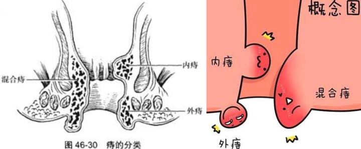 痔疮发展到什么程度了适合手术,痔疮目前国内最先进的手术