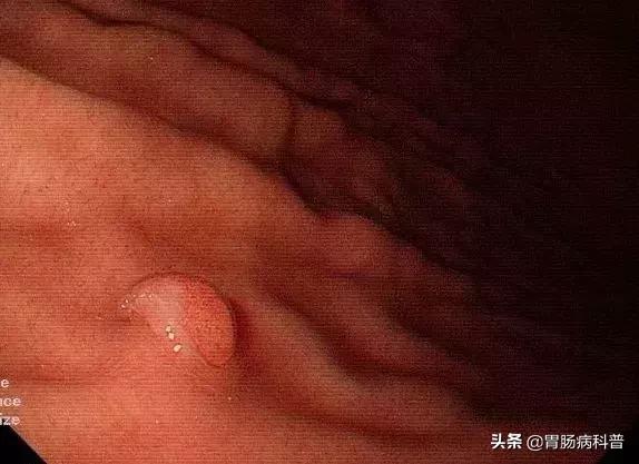 为什么胃息肉会癌变,如何判定胃息肉有没有癌变