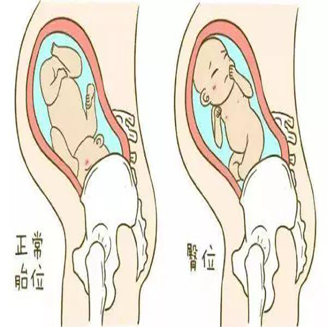 33周头位应该不会再变了吧,33周头位还会转胎位吗
