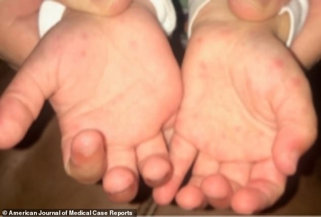 抗病毒治疗阿昔洛韦,抗病毒药膏阿昔洛韦