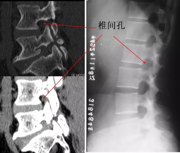 颈椎腰椎疾病ct及mri诊断,腰椎ct可以发现肠部病变吗