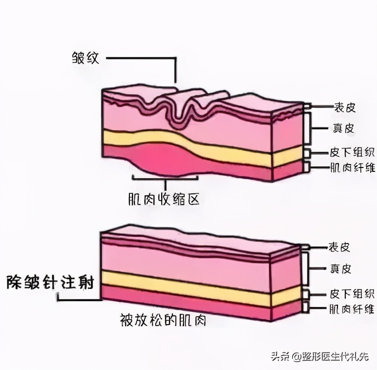 肉毒素最全讲解,肉毒素的十问