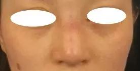 年轻的时候整容老了脸会崩吗,整过形的脸老了好不好