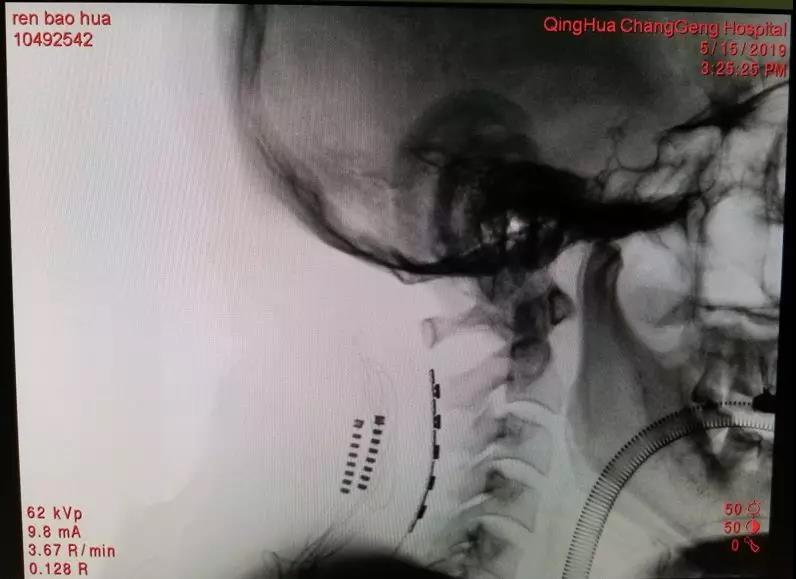 微创脊髓电刺激手术,北京宣武神经外科脊髓电刺激术