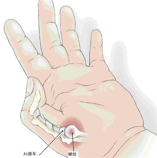 写字写多了手上有个包怎么办,手上无缘无故起个包按着很疼