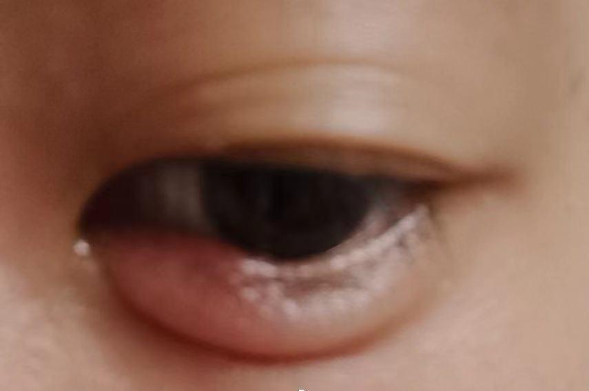 针眼、跖疣、毛囊炎，化脓了怎么办？千万别挤