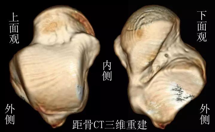 踝关节撞击症问诊,踝关节撞击综合征的x线表现