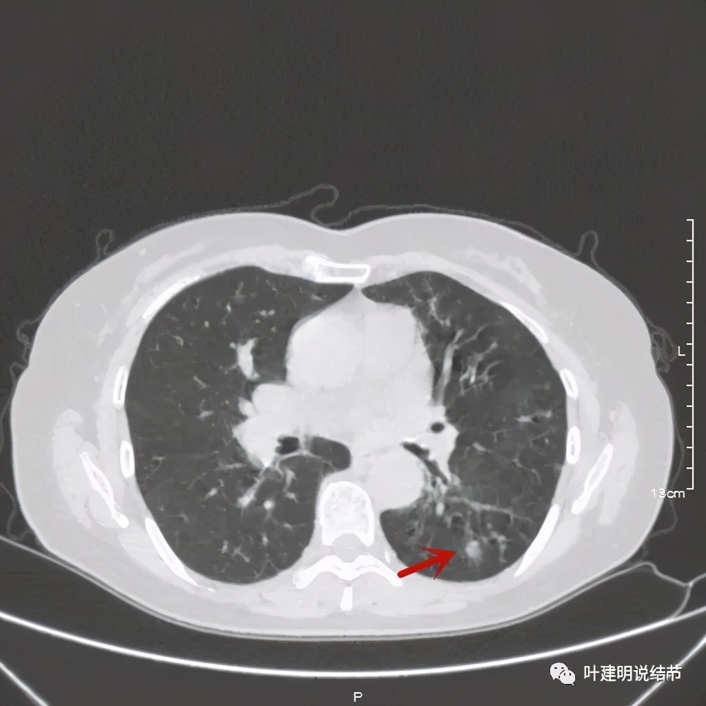 这样的实性结节伴小空洞会是肺癌吗？