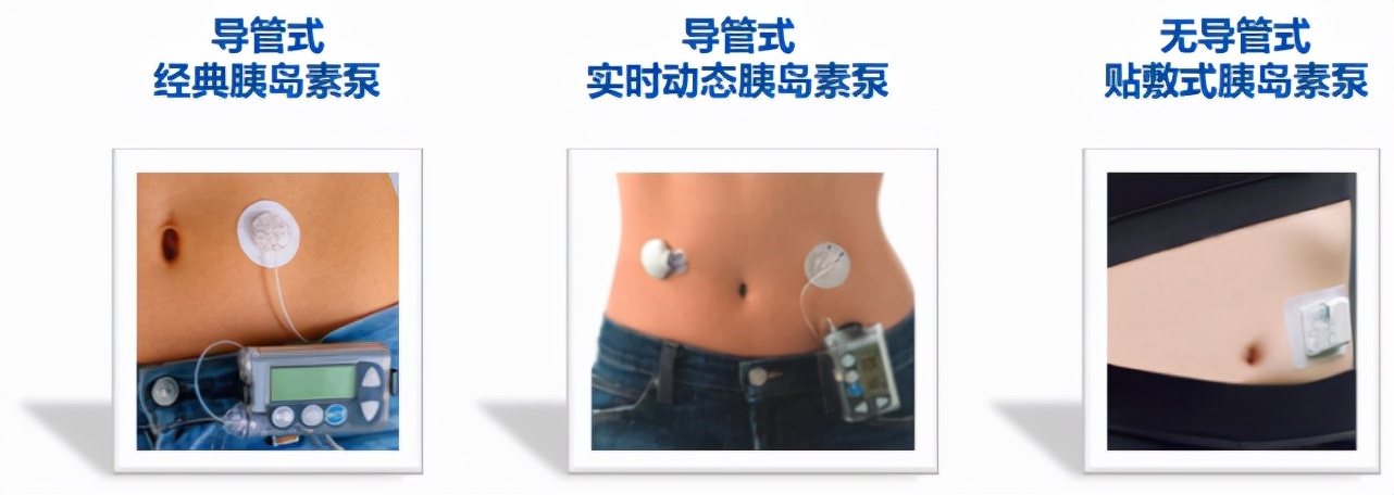 胰岛素泵使用指南最新,胰岛素的最新指南
